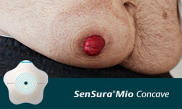 Is your stoma on an area with bulges and curves?